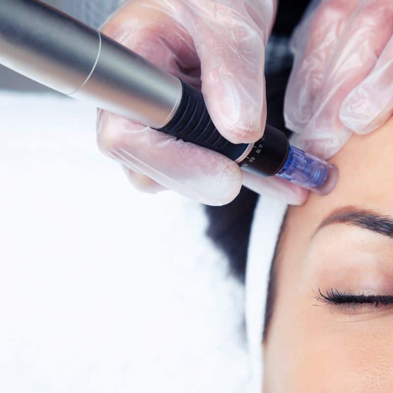 Morpheus8 treatment Higham Ferrers from Lipo Sculpt - Book in today!