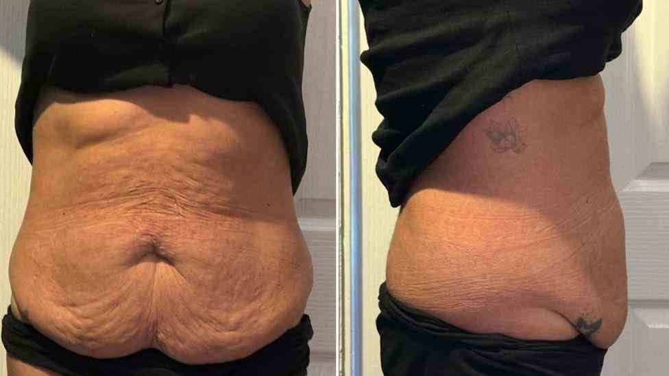 Lost the Weight but Not the Loose Skin? What You Should Know 1 Is It Definitely Loose Skin Higham Ferrers?