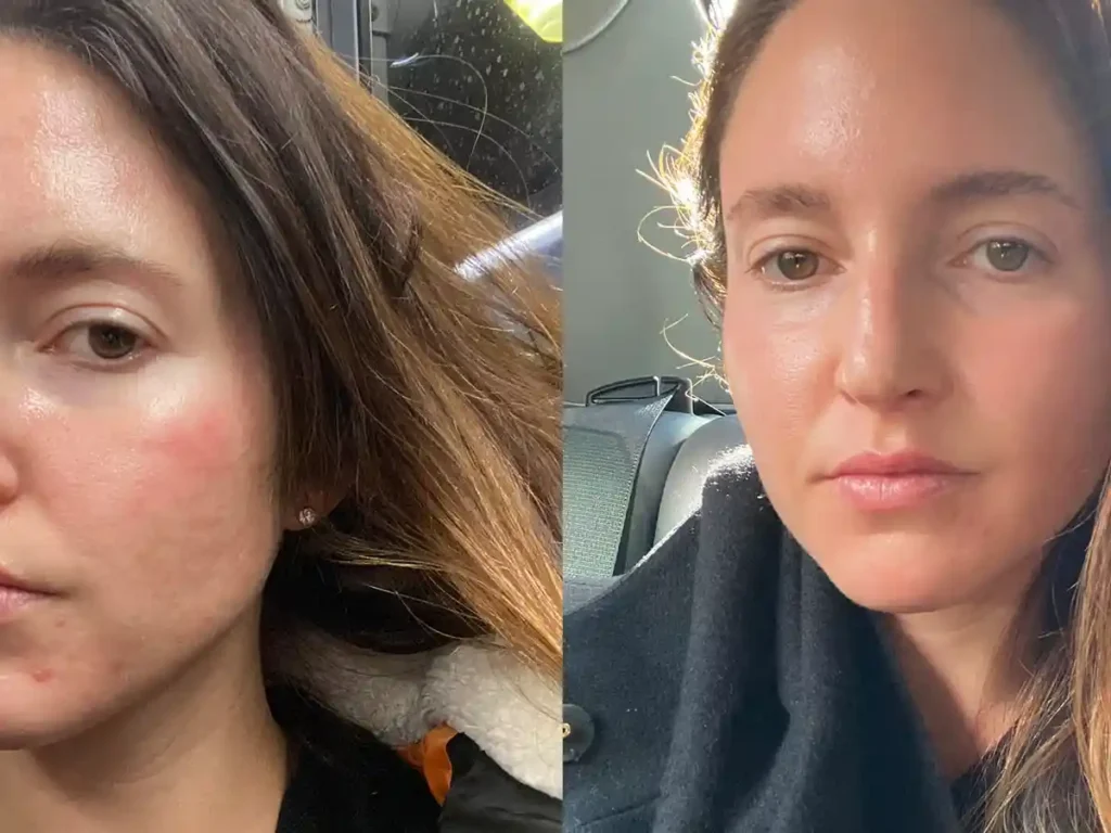 Explaining Total Skin Tightening Treatment and What to Expect 3 Explaining Total Skin Tightening Treatment and What to Expect